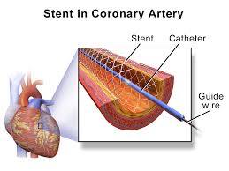 cardiac stent